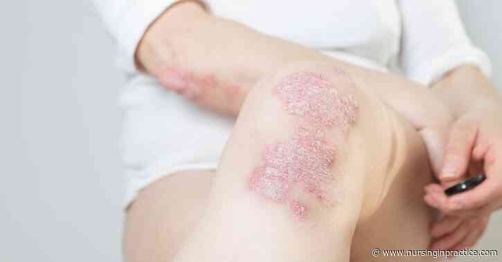 Psoriasis in primary care: ten tips for nurses