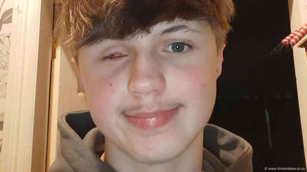 North East teen lost eye in firework accident as NHS warns of rising injuries